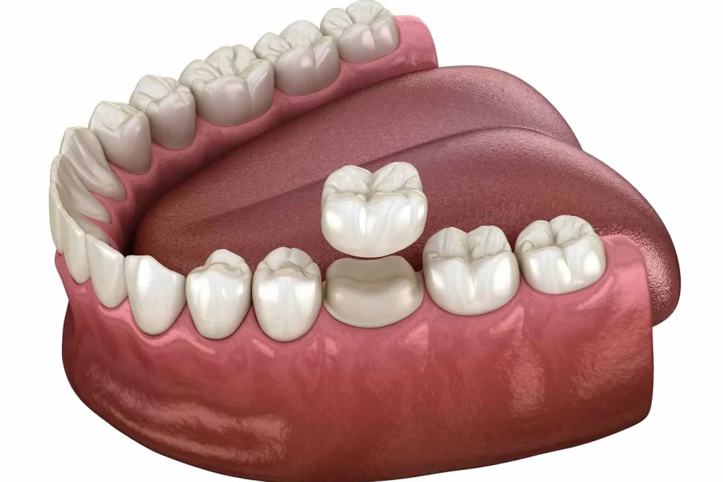A patient having a dental crown fitted at McQuary Dental in Tallahassee