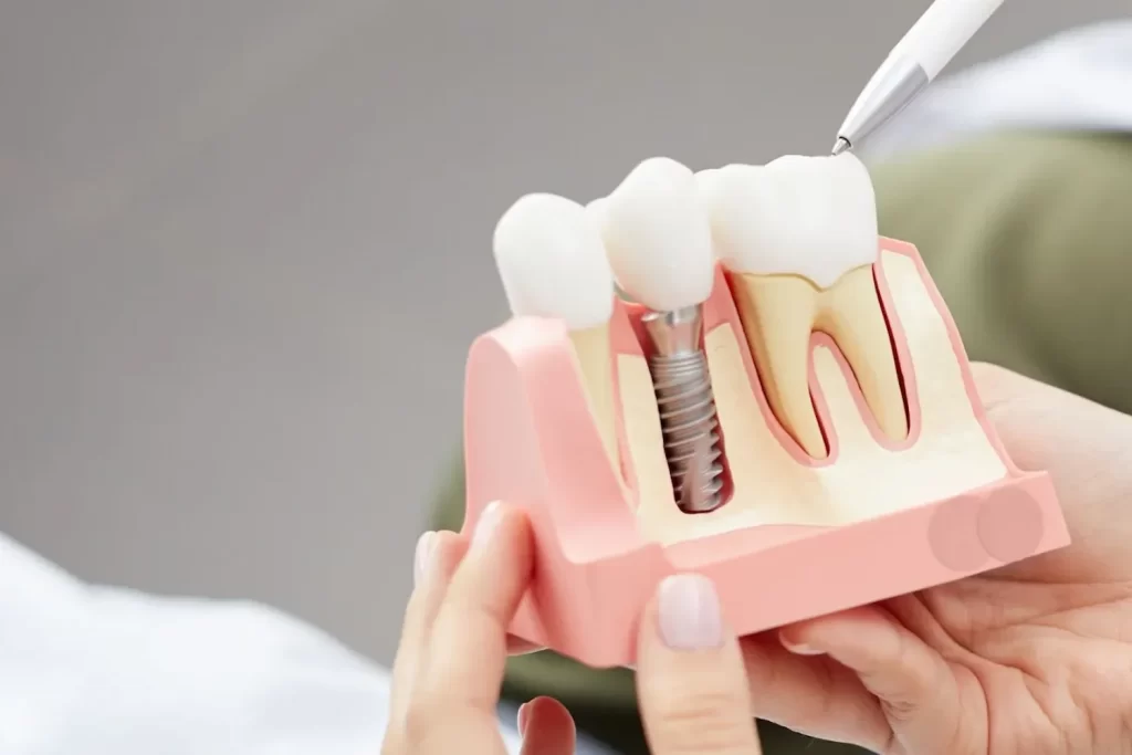 A dentist explaining a dental implant model to a patient at McQuary Dental